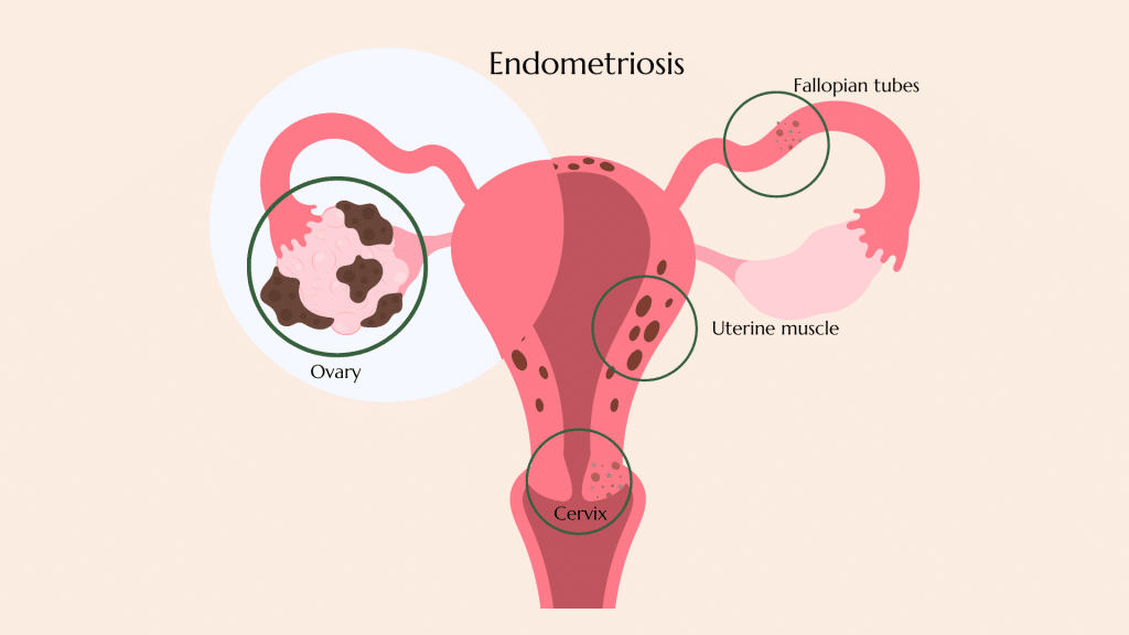 Medical illustration of endometriosis