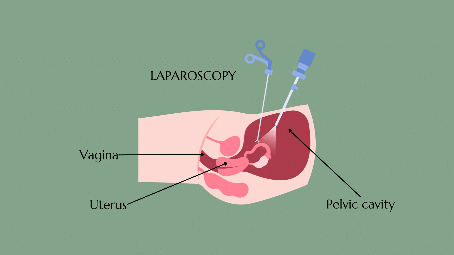 IUD 10