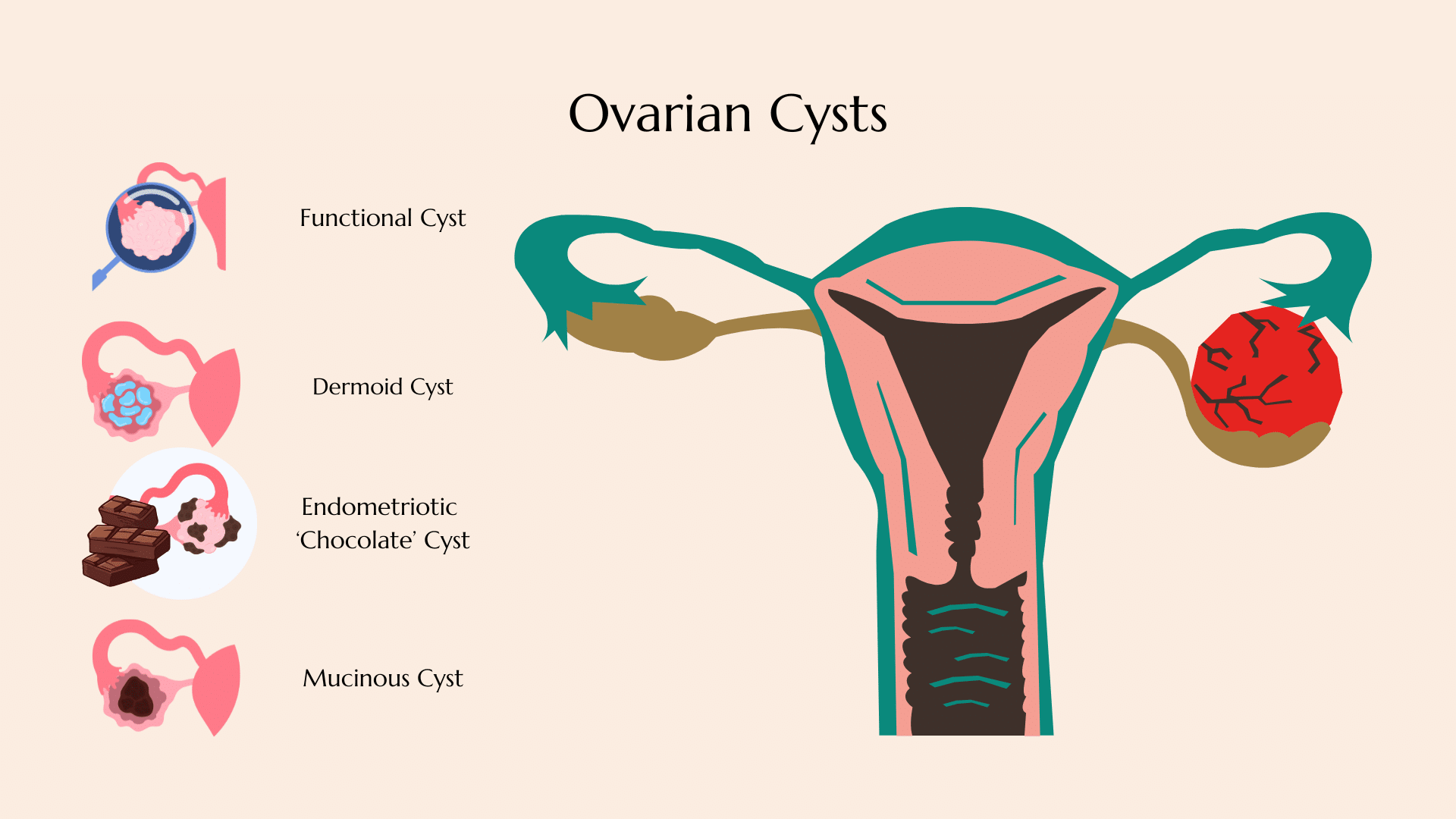 Ovarian Cyst Singapore