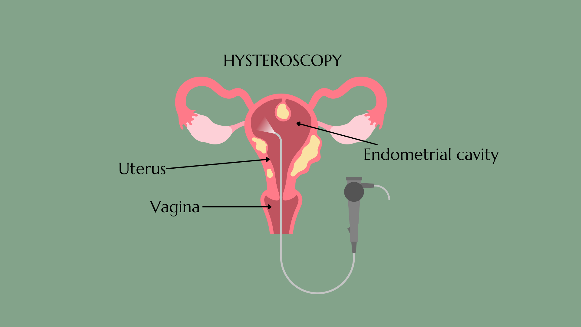 IUD 9