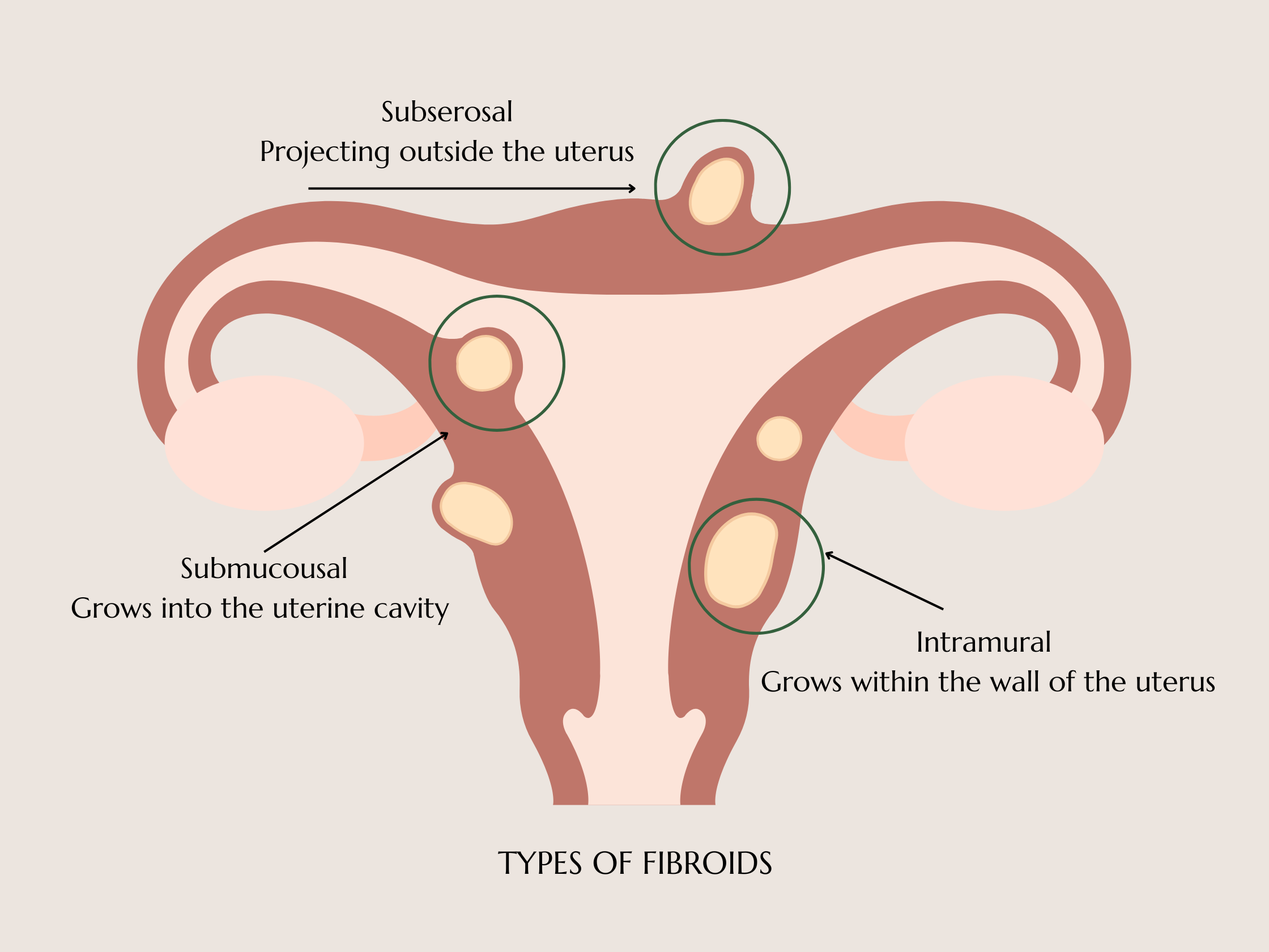 types of fibroids